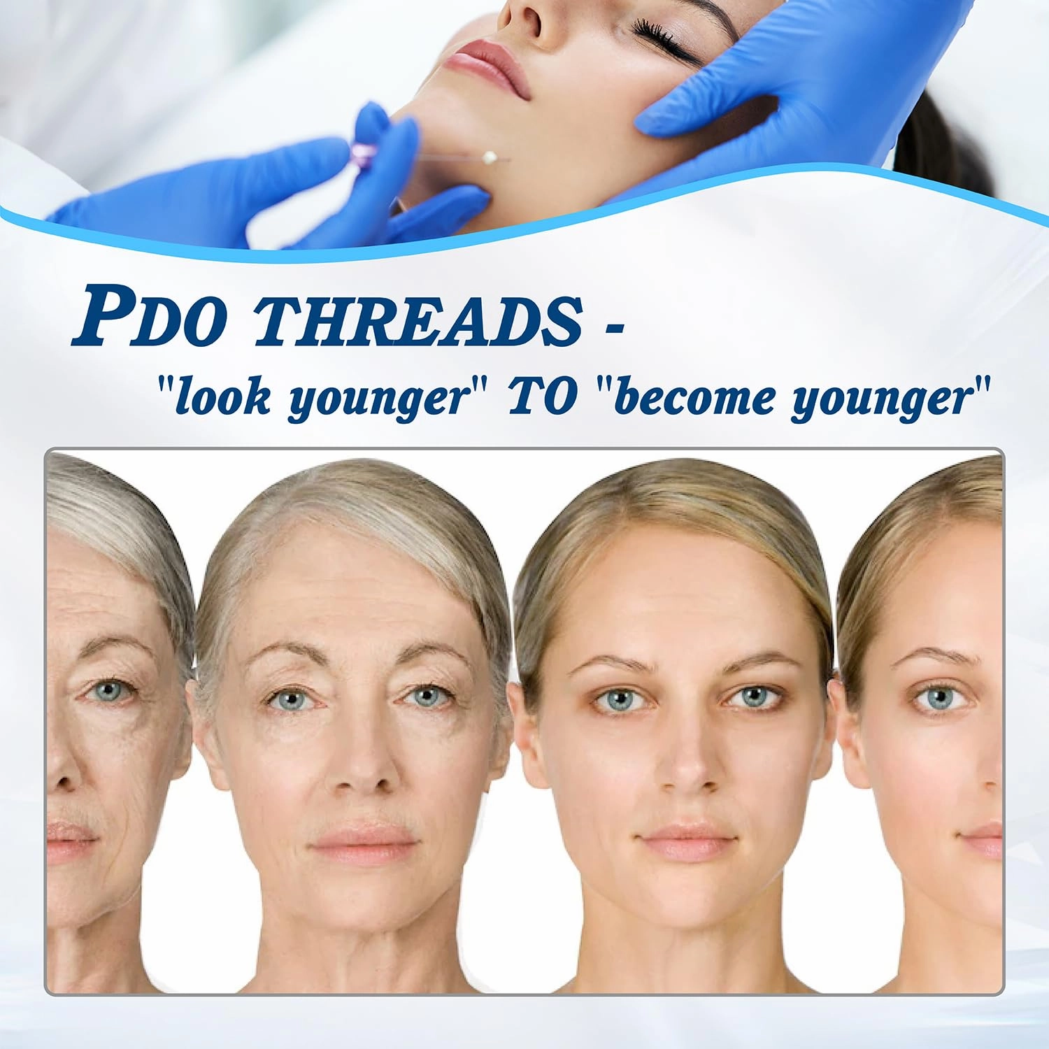 Pdo Threads for Face Lift Mono Screw Type (26G60MM) Smoothing Wrinkles PDO Thread Lift for Whole Body with Sharp Tip 20pcs